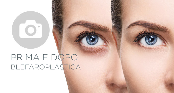 foto prima e dopo liposuzione