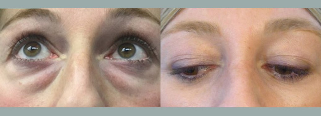 Foto prima e dopo Liposuzione Blefaroplastica