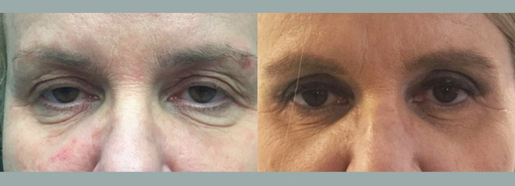 Foto prima e dopo Liposuzione Blefaroplastica