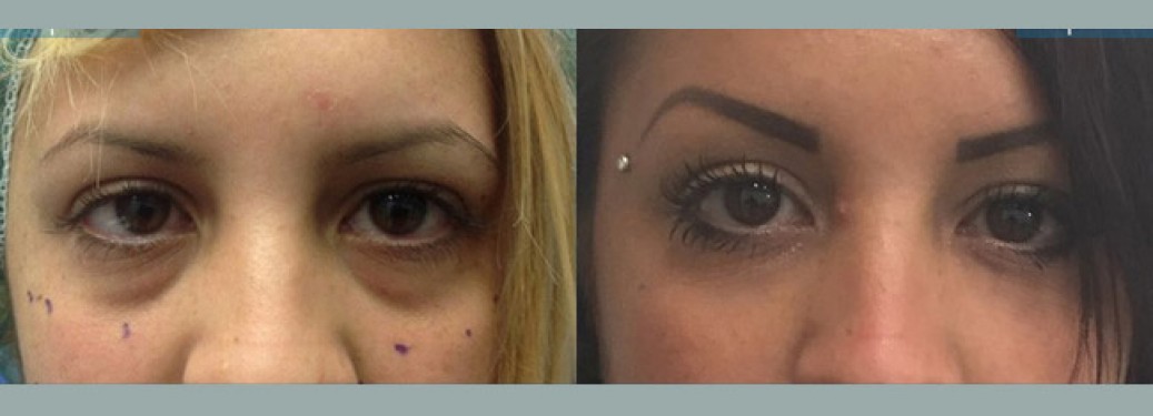 Foto prima e dopo Liposuzione Blefaroplastica