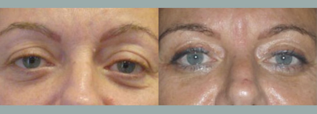 Foto prima e dopo Liposuzione Blefaroplastica