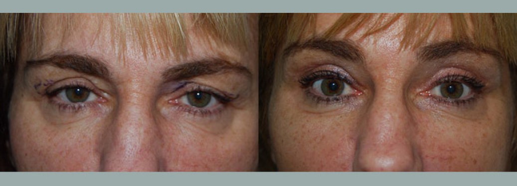 Foto prima e dopo Liposuzione Blefaroplastica